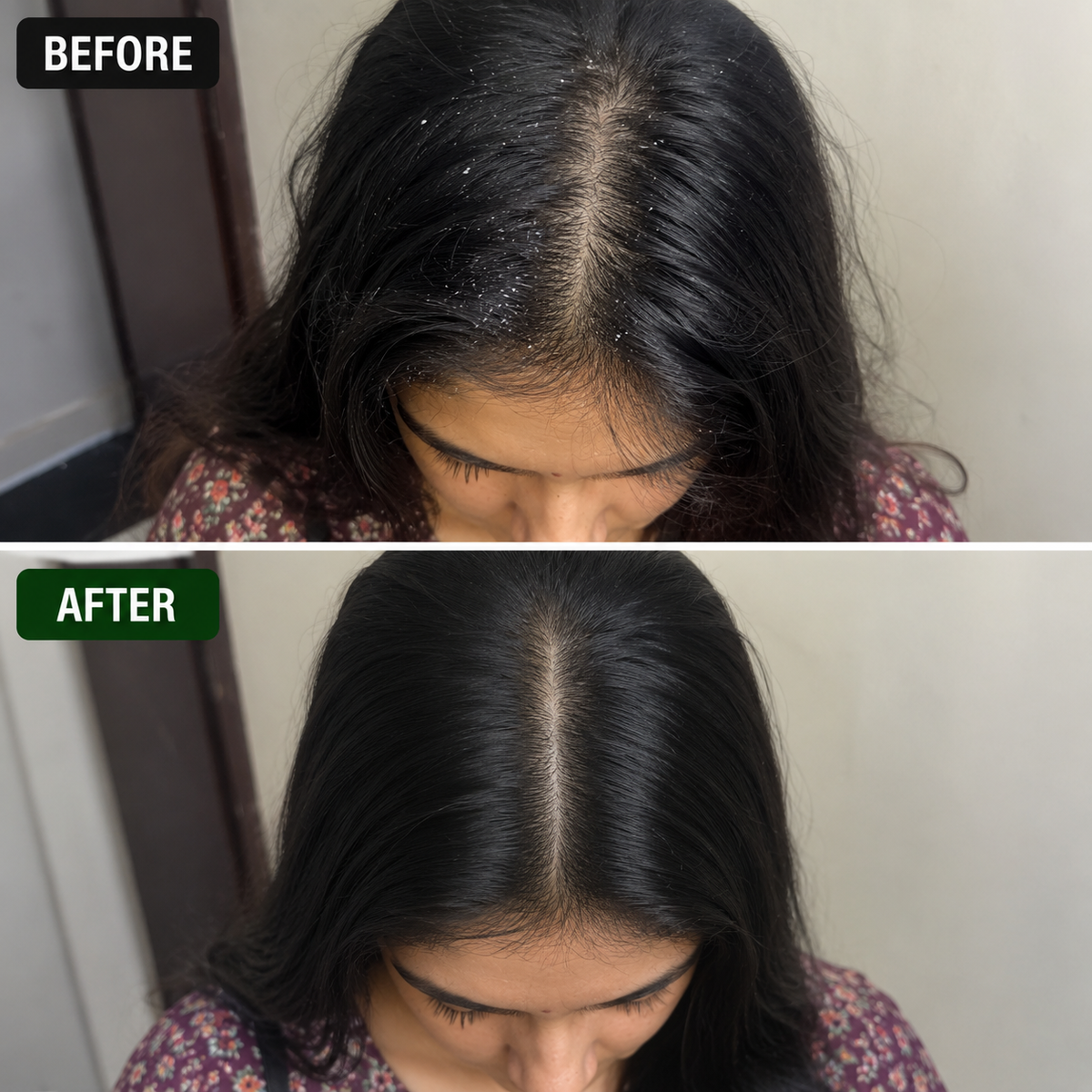 Electric Chemical-Free Head Lice Removal Comb